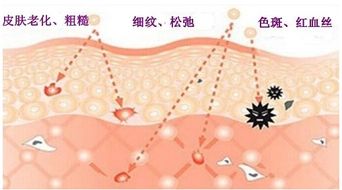 光子嫩肤技术与传统术式有何区别  第1张