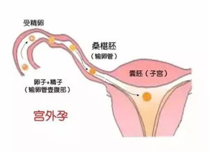原创医生建议切除我一侧输卵管，会影响怀孕吗？