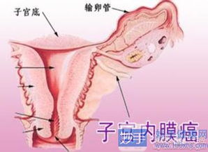 子宫内膜癌都能做手术吗