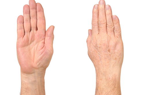 长期在酒店客房部工作手指头和手背长期裂口是什么原因呢如何治疗？