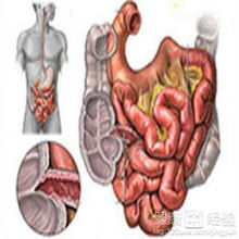 得了结肠癌应该怎样调理