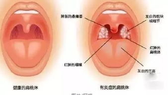 扁桃体发炎怎么办 这些情况下切除扁桃体对孩子会更好