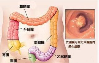 直肠癌基因检测治疗