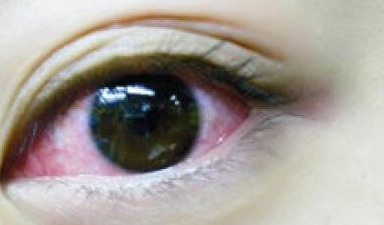 红眼病一般多久能好 红眼病几天才能好