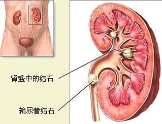 多运动可促进隐性肾结石排出,一起来看看是什么原理