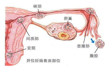 异位妊娠 竟然只是因为“一道疤”