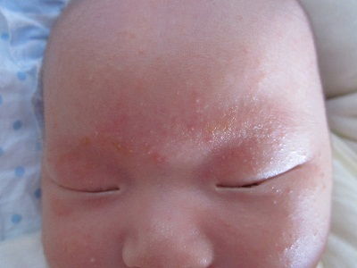 婴儿湿疹的原因(婴儿湿疹是什么原因)