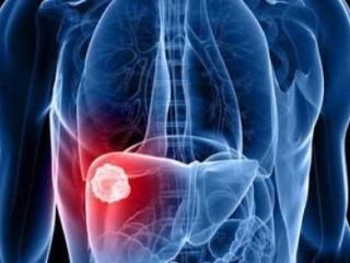查出肝癌还能活多久 中医肿瘤专家帮你分析影响因素