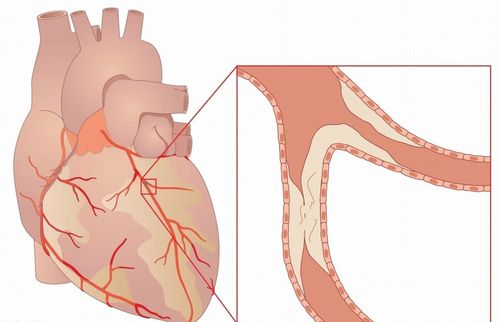平时没有胸闷 胸痛等冠心病症状,照样发生心肌梗死,这是怎么回事