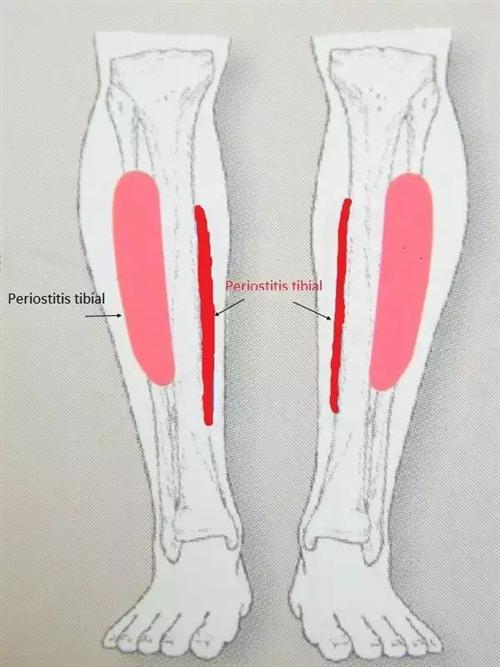 脚踝骨膜炎怎么治疗