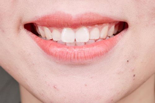 牙齿上黄黄的东西是怎样形成的,为何还有异味 如何才能清除