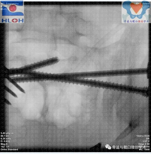 脊柱骨盆不连 骨盆垂直不稳定型骨折合并股骨干粉碎性骨折的诊疗思考