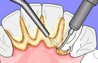 洗牙和牙周刮治一样吗 