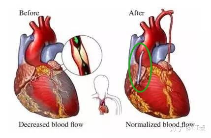 心血管支架手术算不算冠状动脉旁路手术 