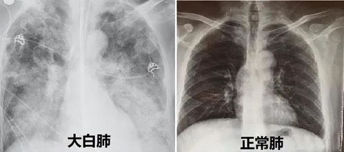新冠患者的肺部分白肺（新冠双肺变白） 第1张