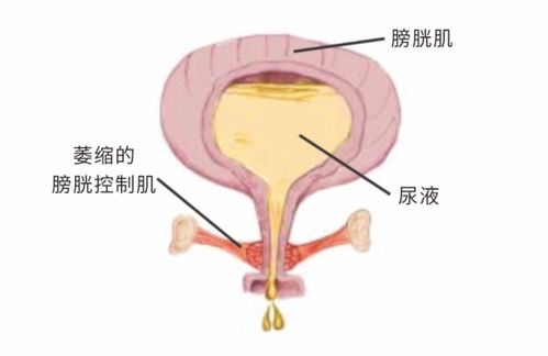 女性产后黄金期,请尽快进行盆底肌康复训练