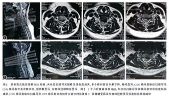 破裂型颈椎间盘突出症患者脱出髓核组织自发吸收1例 