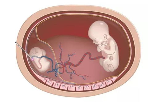 试管婴儿移植的多个胚胎都存活了,是否需要进行减胎手术