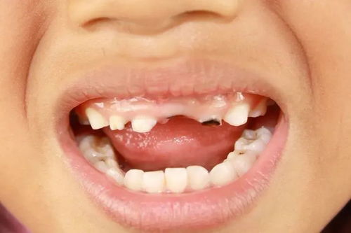 4岁男孩牙齿几乎全黑,最伤孩子牙齿的不是糖,而是