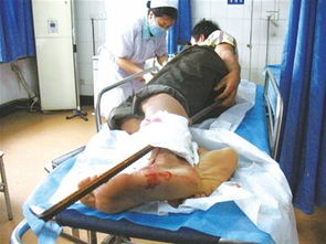 青岛工人跌落3米地基坑手指粗钢筋扎穿小腿 