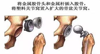 关于人工关节置换,您所担心的那些事