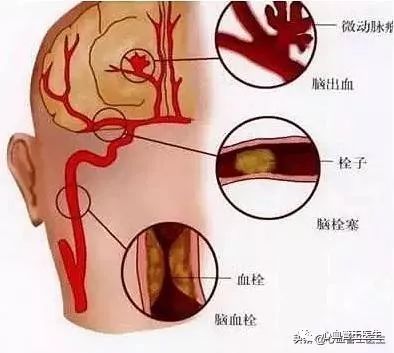 半身不遂,怀疑脑梗,赶紧服用阿司匹林抗血栓,为啥加重了病情