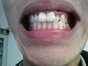 牙齿矫正 主要是门牙突出 是拔牙好还是磨牙好呢 