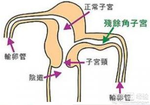 怀孕后发现子宫畸形怎么办