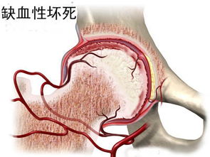 全国股骨头坏死最好的医院是怎样分的？