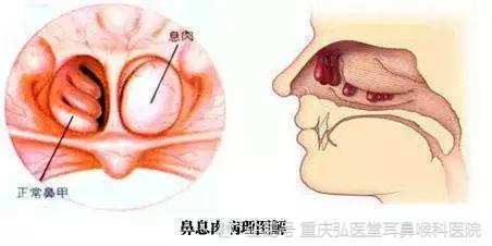 鼻息肉手术有什么危险