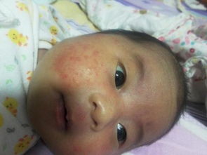 宝宝起湿疹怎么办，宝宝总是反复湿疹怎么办