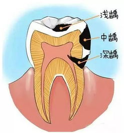 孩子蛀牙不用补 你能保证孩子换牙前,牙不痛吗