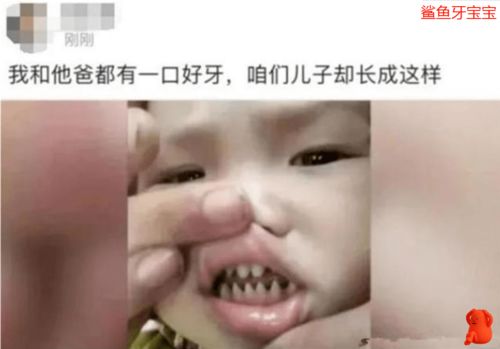 宝宝张嘴露出两排 鲨鱼牙 ,表面霸气实则害娃,正确护牙很重要