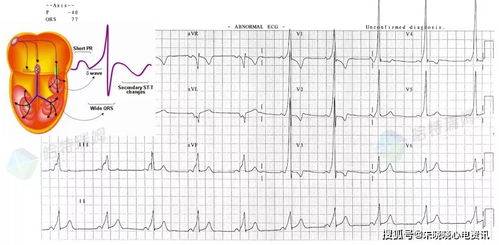 形形色色的T波倒置,你了解多少