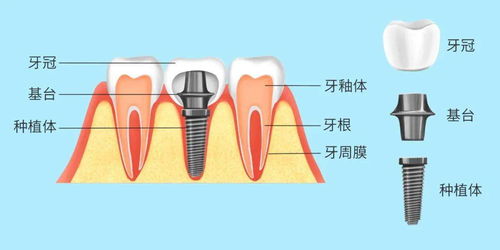 种植牙也会脱落 怎么保护它 看完你就知道了