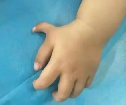宝宝因为多了一根手指被嘲笑 多指畸形,还能矫正吗