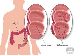 多大的肠息肉必须切除说说你身边的肠癌患者(一般多大的肠息肉会癌变)