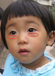 儿童黑眼圈是怎么回事