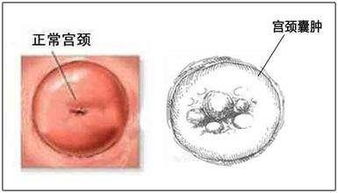 请问一下宫颈轻度靡烂用微波治疗对以后生孩子会不会有影响，用什么方法治疗最好