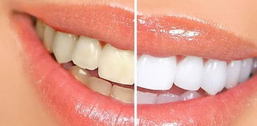 女人还担心黄牙么 教如何消除牙垢,让牙齿变白 