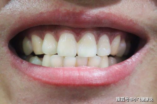 为何大多数日本人牙齿都不整齐 哪些原因,导致日本人牙齿歪斜