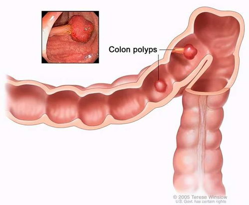 每5个人中就有1人患肠息肉,会癌变吗
