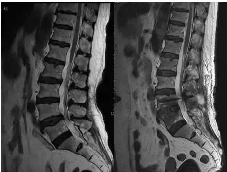 这 4 种特殊的腰椎管狭窄 MRI 表现,你忽视了吗