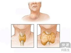 什么是甲状腺肿瘤(什么是甲状腺肿瘤 甲状腺肿瘤和甲状腺癌一样吗)