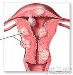 子宫肌瘤手术，子宫肌瘤手术怎么做