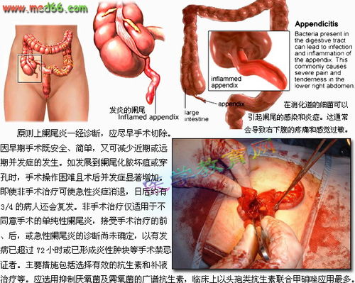 右小腹痛是怎么回事 会不会是阑尾炎 