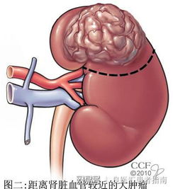 肾癌保肾手术患者最需要知道的四件事