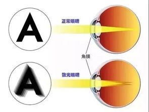 近视手术能矫正散光吗