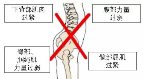 有一种 翘臀 叫骨盆前倾 你中招了吗 