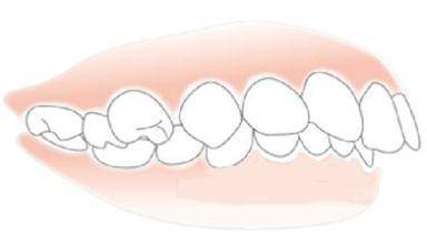 牙齿矫正中的深覆合和深覆盖有什么区别呢 